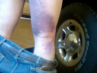 Steve's injury.jpg Steve's injury.jpg