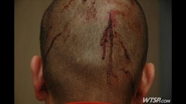 zimmerman head injury.jpg